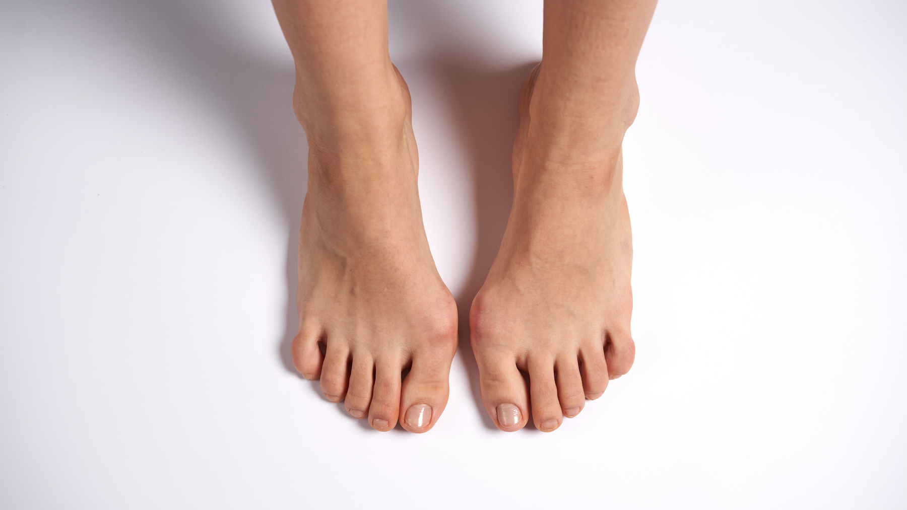 Close up of bare feet with visible bunions